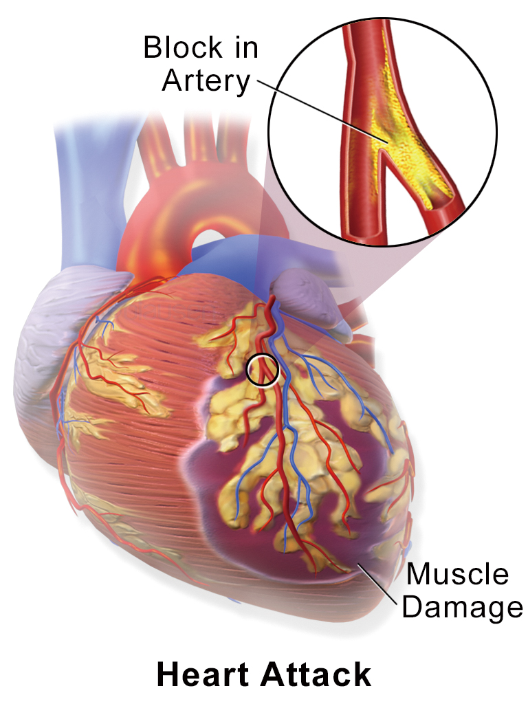 心肌梗塞為支配心臟之冠狀動脈血栓引起